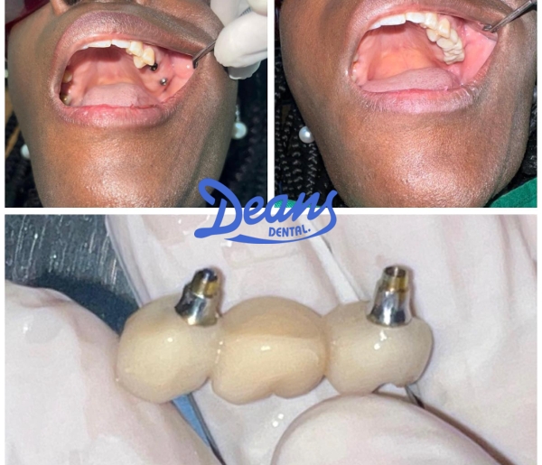 Dean's Dental Implant patient