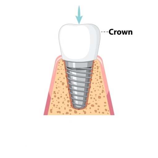 Dean's Dental Implant