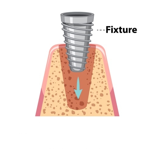 Dean's Dental Implant one