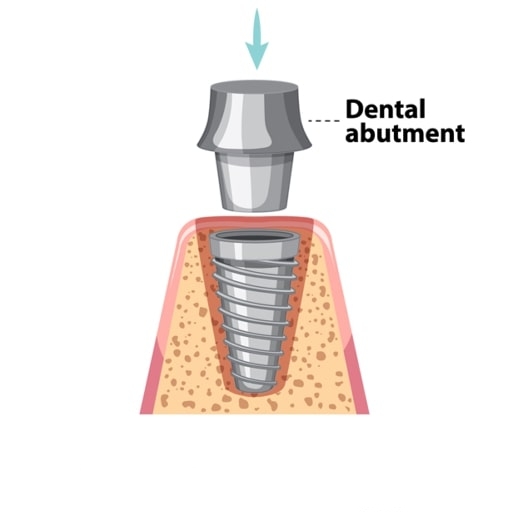 Dean's Dental Implant three