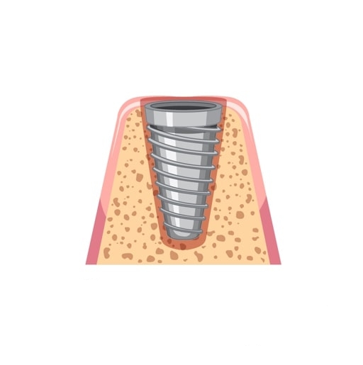 Dean's Dental Implant two