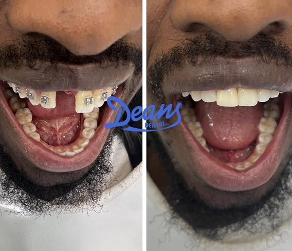 Dean's Dental Implant patient